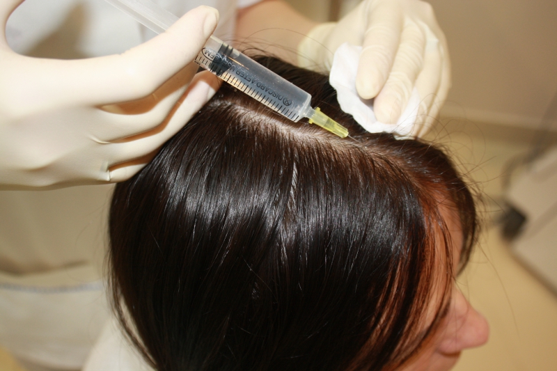 Мезотерапия волос в Красноярске