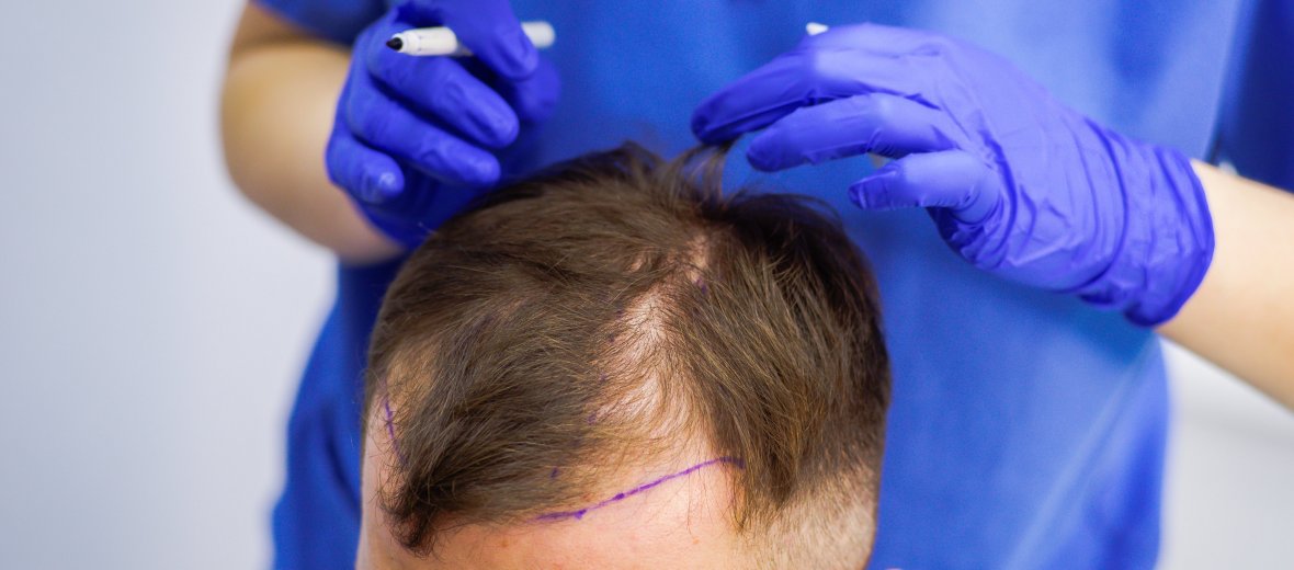Сколько стоит пересадка волос на голове у мужчин красноярск thumbnail