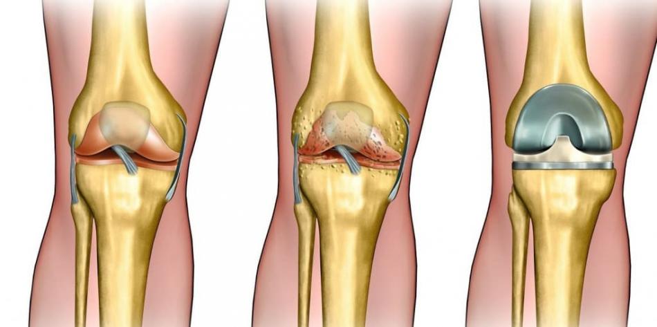 Как проходит операция эндопротезирования коленного сустава.